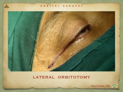 Orbital Surgery.085.jpeg