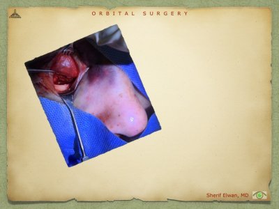 Orbital Surgery.089.jpeg