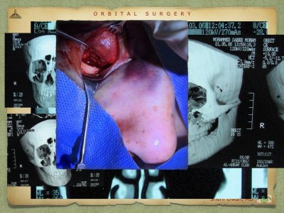 Orbital Surgery.092.jpeg