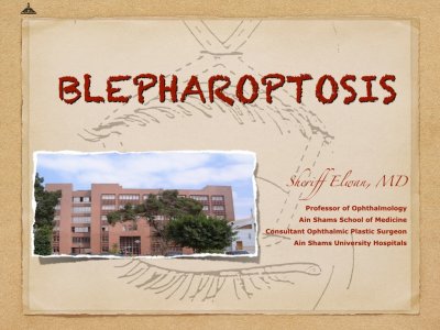 Blepharoptosis