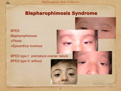 Blepharoptosis.027.jpeg