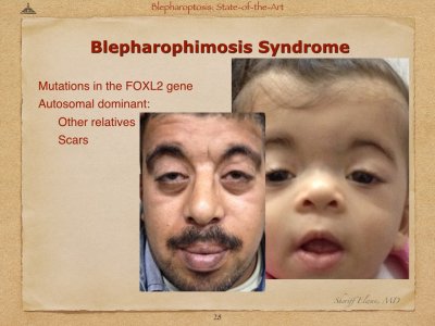 Blepharoptosis.028.jpeg
