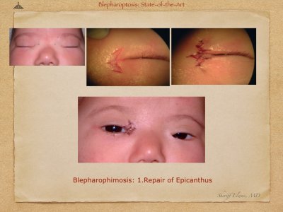 Blepharoptosis.051.jpeg