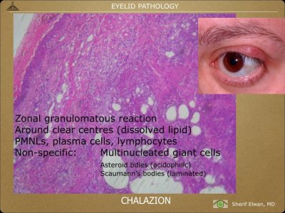 Pathology - Eyelids.002.jpeg