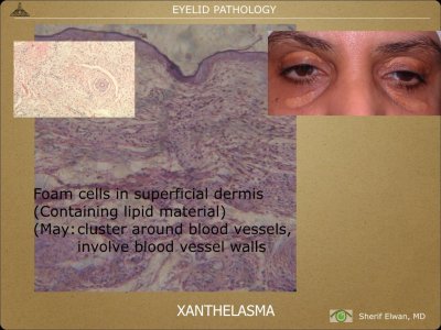 Pathology - Eyelids.005.jpeg