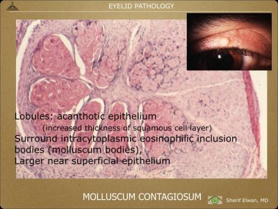 Pathology - Eyelids.010.jpeg
