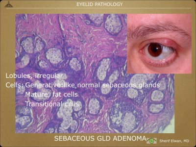 Pathology - Eyelids.012.jpeg