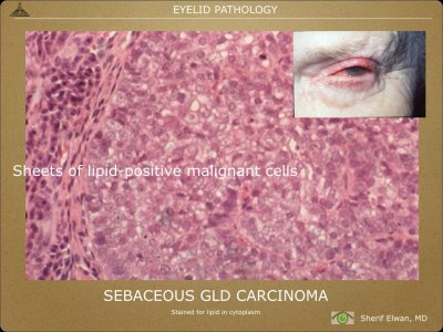 Pathology - Eyelids.013.jpeg