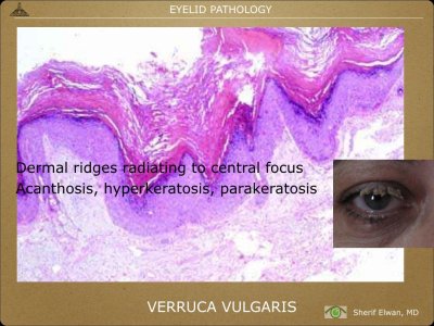Pathology - Eyelids.014.jpeg