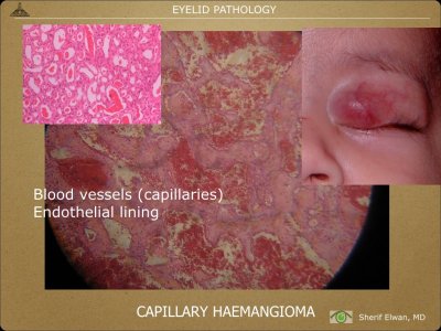 Pathology - Eyelids.016.jpeg