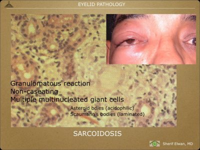 Pathology - Eyelids.019.jpeg
