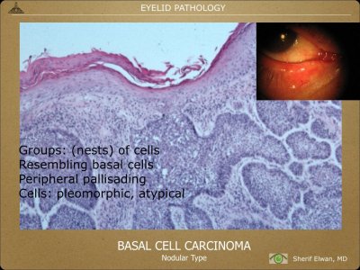 Pathology - Eyelids.020.jpeg