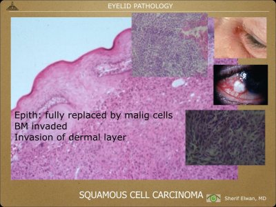 Pathology - Eyelids.023.jpeg