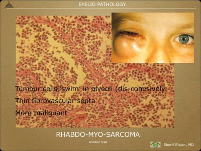 Pathology - Eyelids.025.jpeg