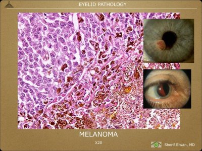 Pathology - Eyelids.027.jpeg