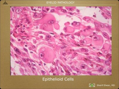 Pathology - Eyelids.032.jpeg