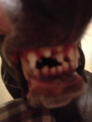 lexis_jaw_fracture_and_maxillectomy
