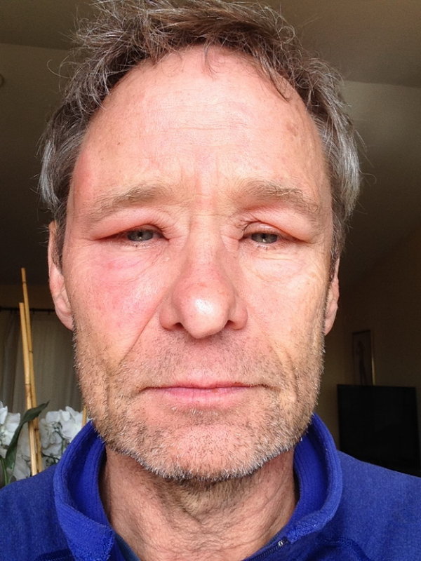 Swelling from bee stings to face