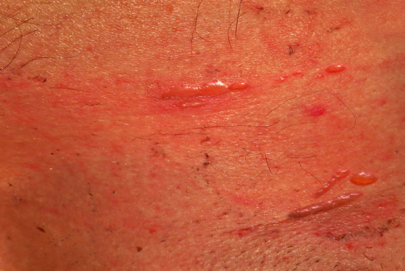 Zones cutanes brles par des arcs lectriques / Multiple burned skin spots by dancing whiplash electric arcs