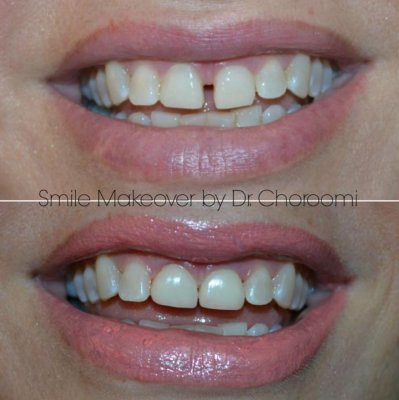 Dental Braces Calabasas Ca