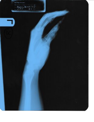 Xray  hand 8-18-14 with R written on it for right hand.jpg