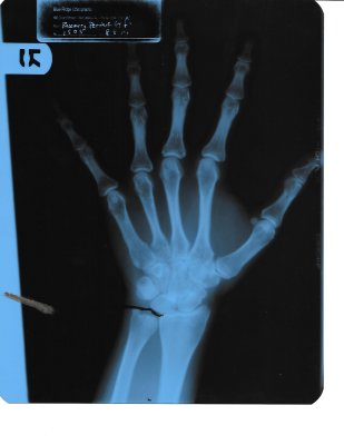 X-rays left hand 8-18-14 Blue Ridge Chiropractic_Page_1.jpg