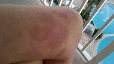 knees bruised from scratching fall 2011 .jpg