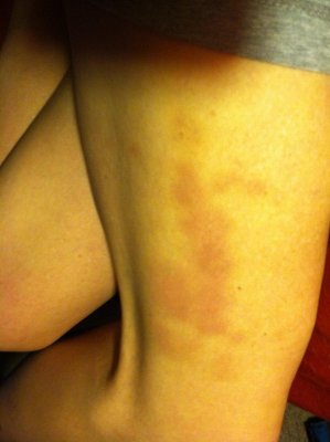 bruises from scratching Jan 22 2013 .JPG