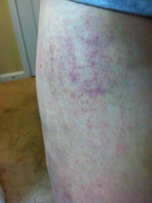 more bruises from scratching Jan 22 2013 2.JPG