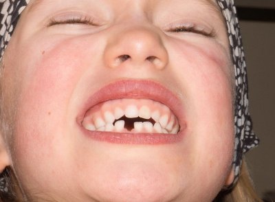 31st Jan first tooth gap _1