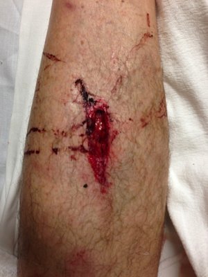 It was so deep it went out of sight under the skin.