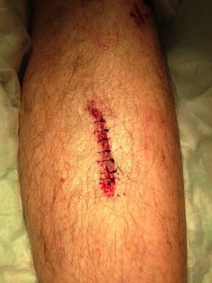 Nice stitch job.