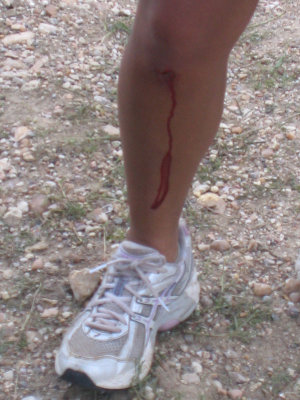 Still bleeding!