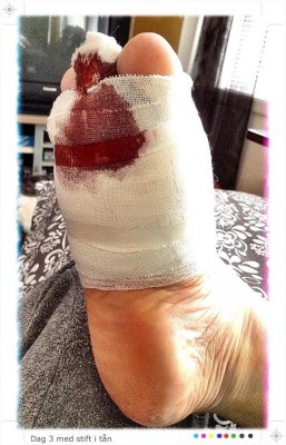 Well, a bit messy after surgery to get my toe back to right position. 