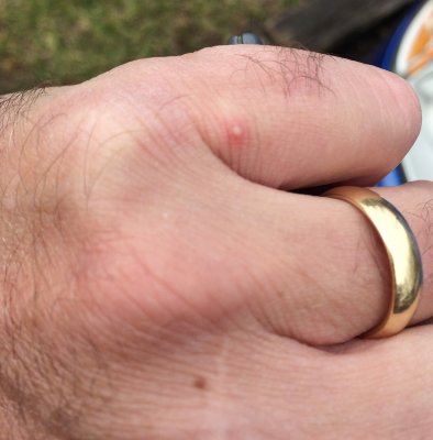 fire ant bites from the levee