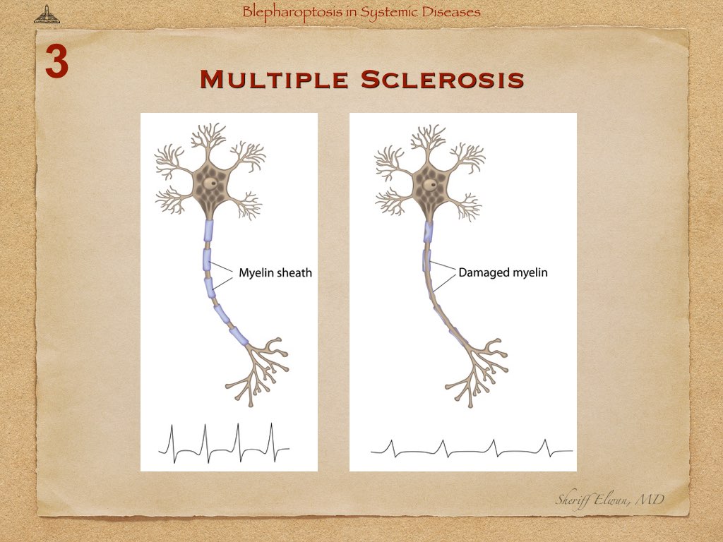 Blepharoptosis in Systemic Diseases.021.jpeg