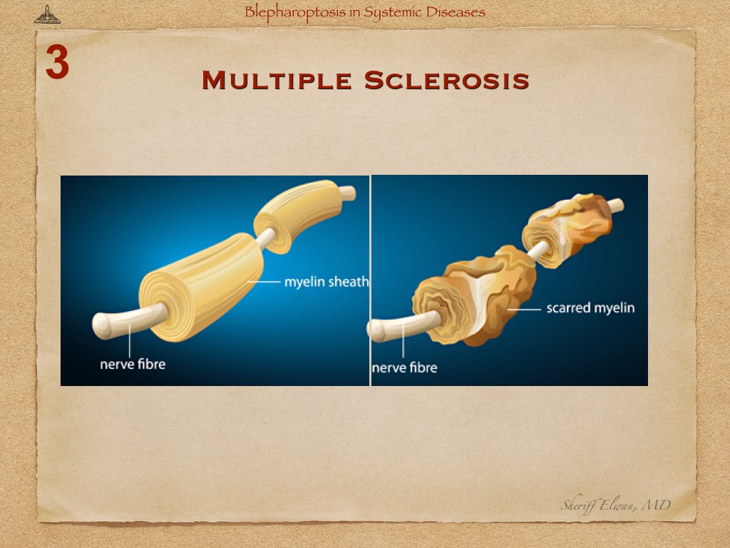 Blepharoptosis in Systemic Diseases.022.jpeg
