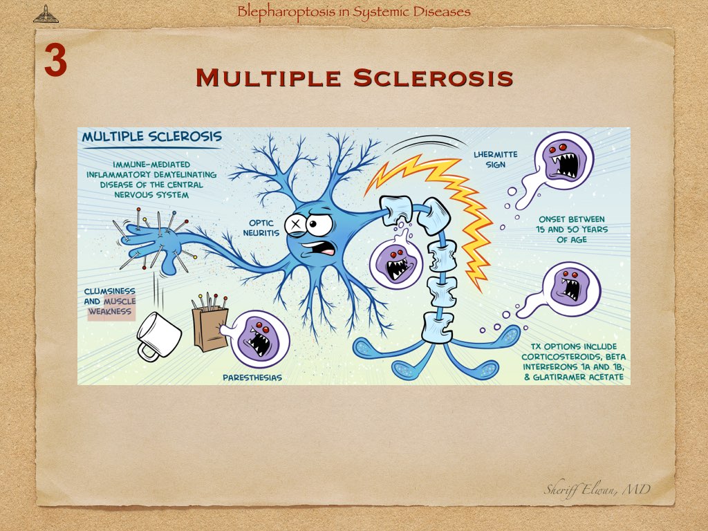 Blepharoptosis in Systemic Diseases.023.jpeg