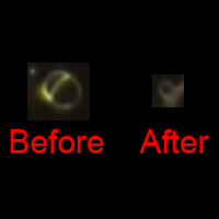 Cyst absorbed after forming SOP