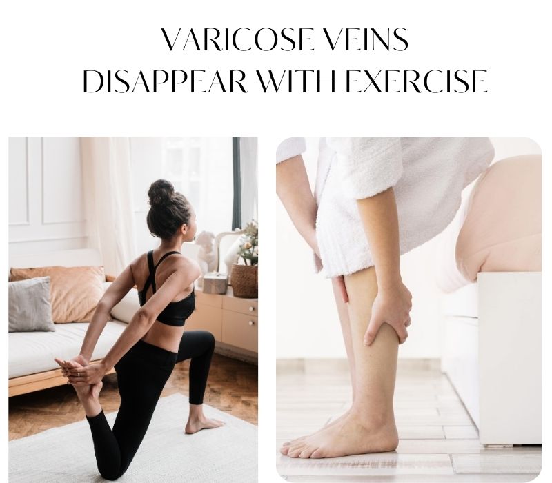  A COMPREHENSIVE GUIDE TO VANISHING VARICOSE VEINS WITH EXERCISE