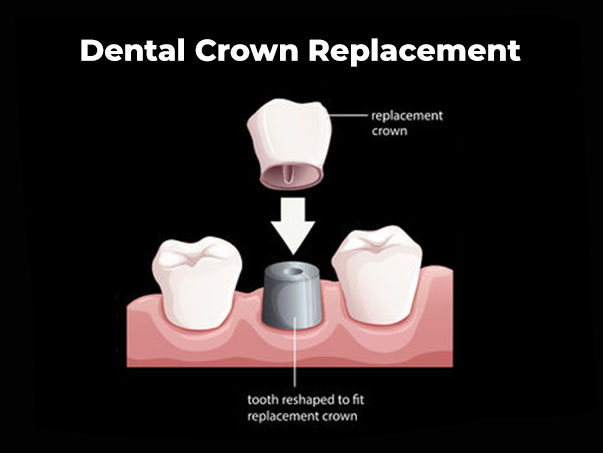 Dental Crown Replacement | Fern Dental