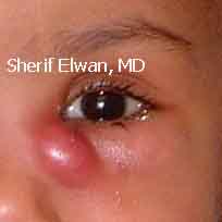 30.Child Acute Dacryo-cystitis