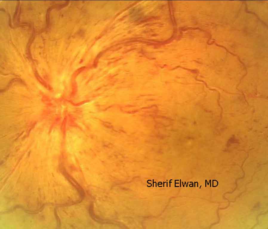 51.Central Retinal Vein Occlusion