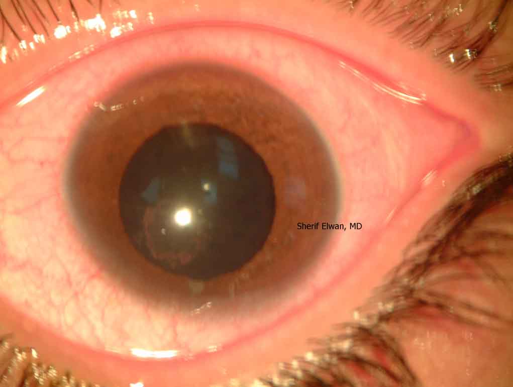 77.Posterior Cortical Cataract