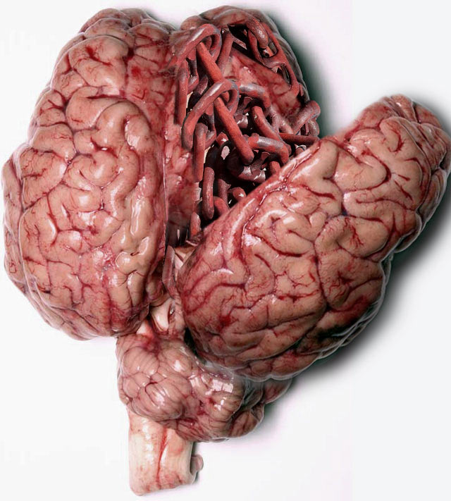 Obsessive Compulsive Disorder
