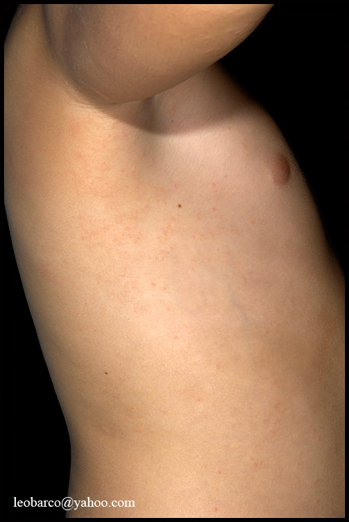 ASYMMETRIC PERIFLEXURAL EXANTHEM OF CHILHOOD_02.JPG