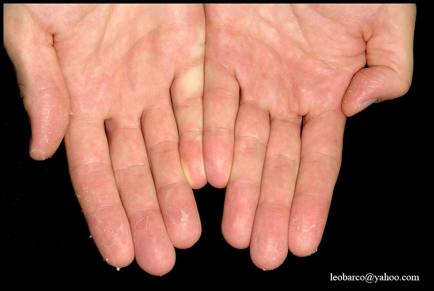 EXFOLIATIVE KERATOLYSIS_01.jpg