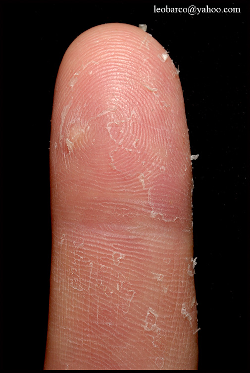EXFOLIATIVE KERATOLYSIS_03.jpg