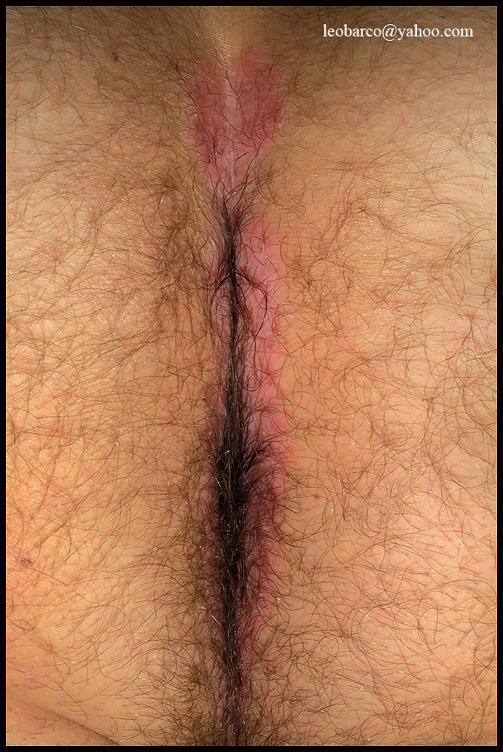 INVERTED PSORIASIS_01.JPG