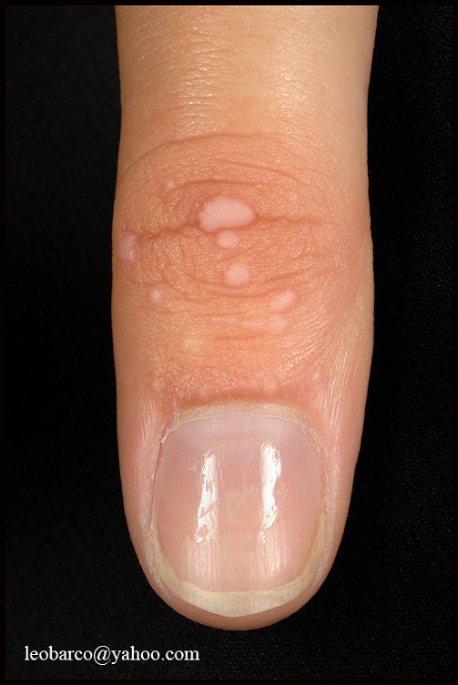 FLAT WARTS_02.JPG